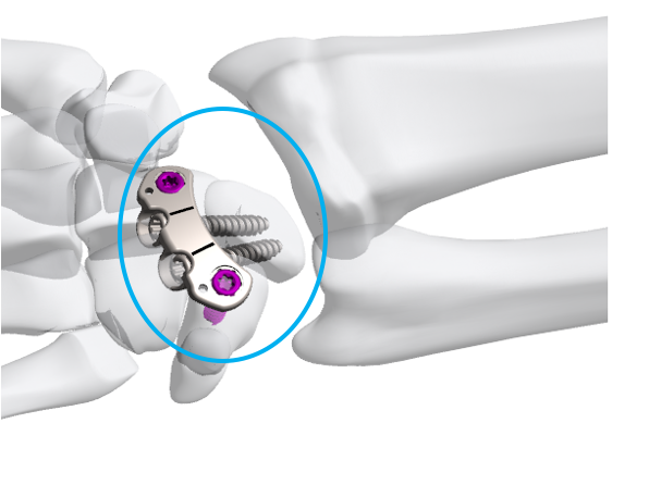 ExsoMed Corporation Announces FDA K Clearance Of Corner Fusion System For Wrist Arthritis